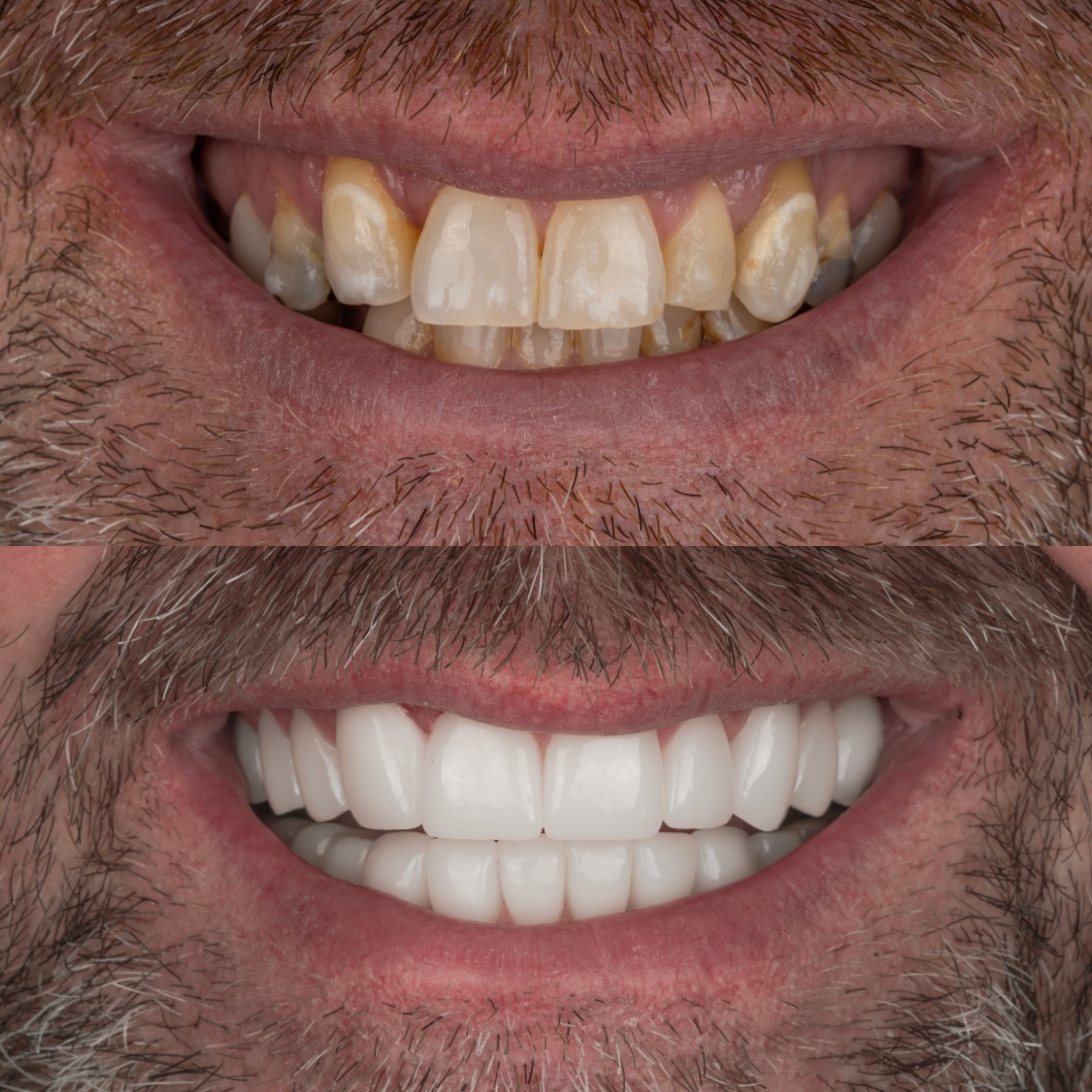 Before and after multiple dental implants and crowns restoration